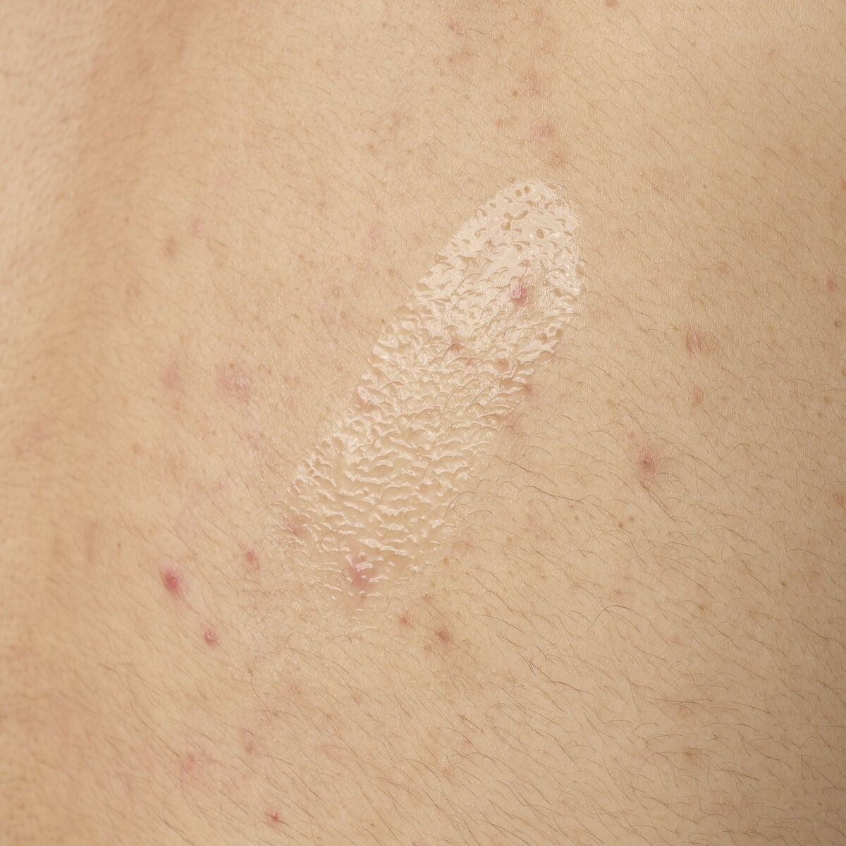 salicylic-acid-0-5-body-serum-a9 ORD-salicylic-acid-05-body-240ml-application.jpg