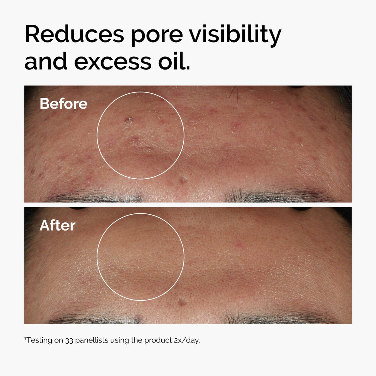 niacinamide-10-zinc-1-p6 ord-niacinamide-zinc-blemish-serum-before-after-pores.jpg