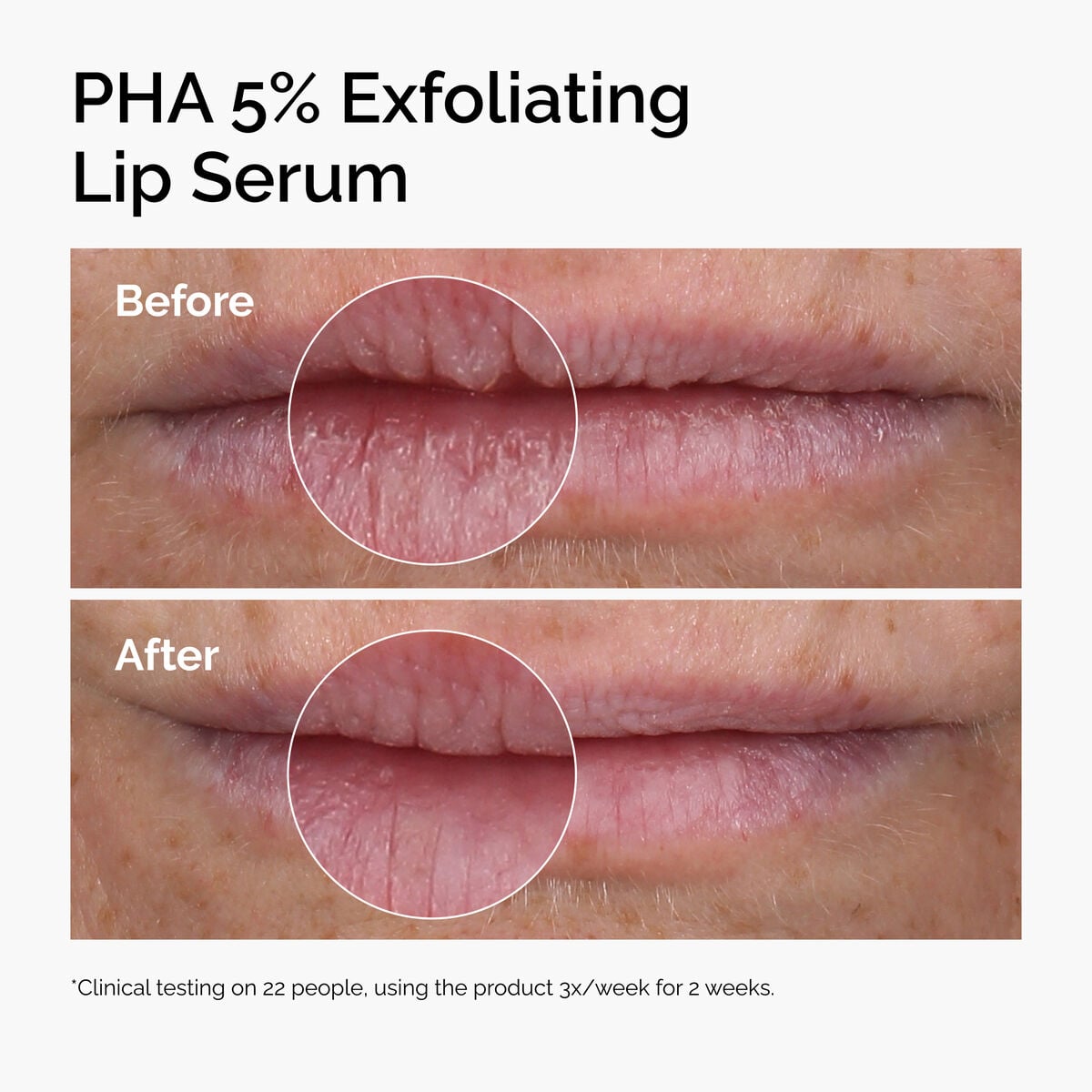 pha-5-exfoliating-lip-serum-q8 ord-pha-5pct-lip-exfoliating-serum-before-after.jpg