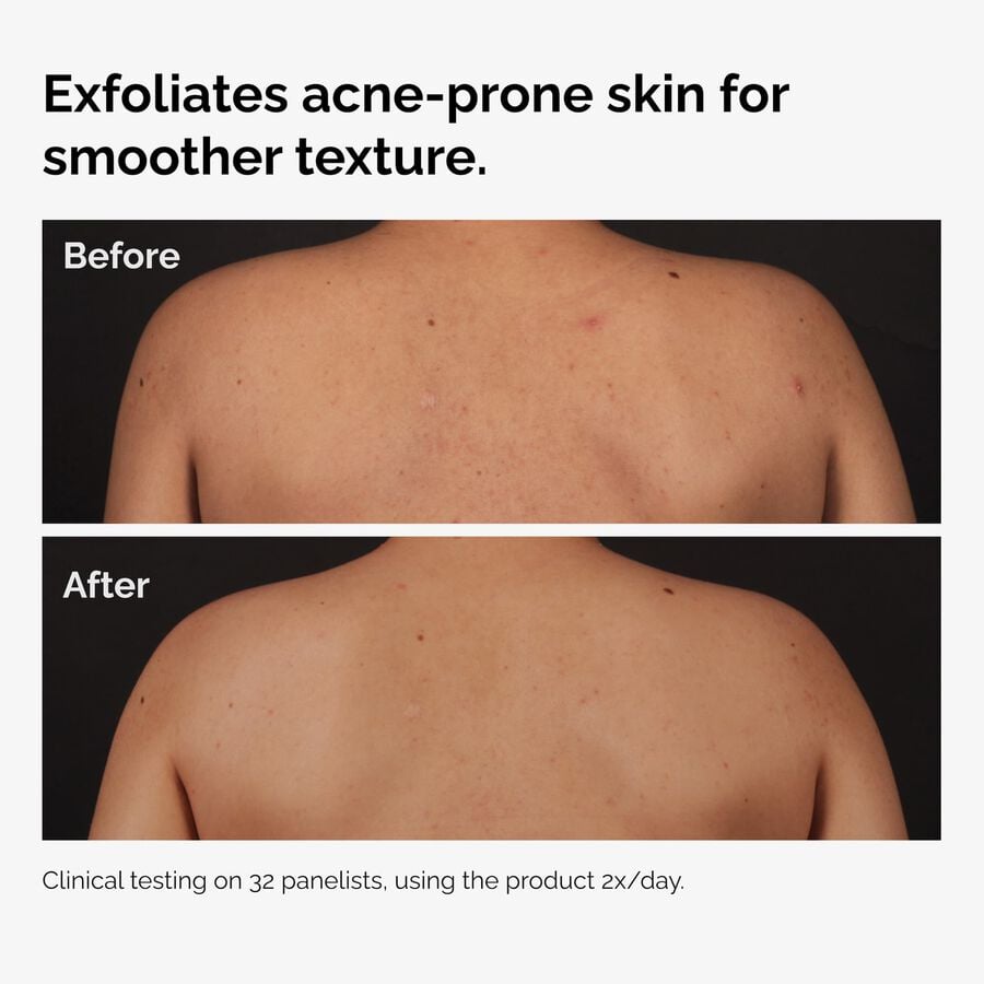 the-body-care-collection-p3 ord-salicylic-acid-body-serum-before-after-graphic-NA.jpg