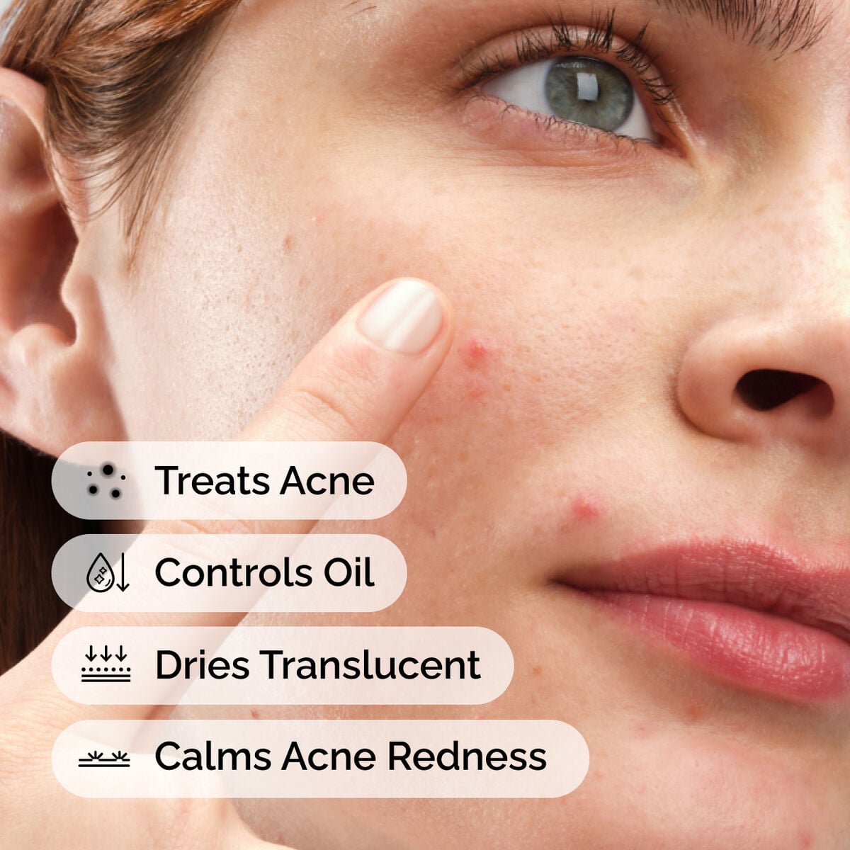 sulfur-10-powder-to-cream-concentrate-b3 ord-sulfur-10pct-powder-to-cream-concentrate-model-application-with-benefits-acne.jpg