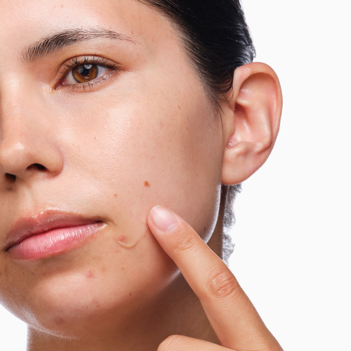 the-acne-set-j3 rdn-the-acne-set-application.png